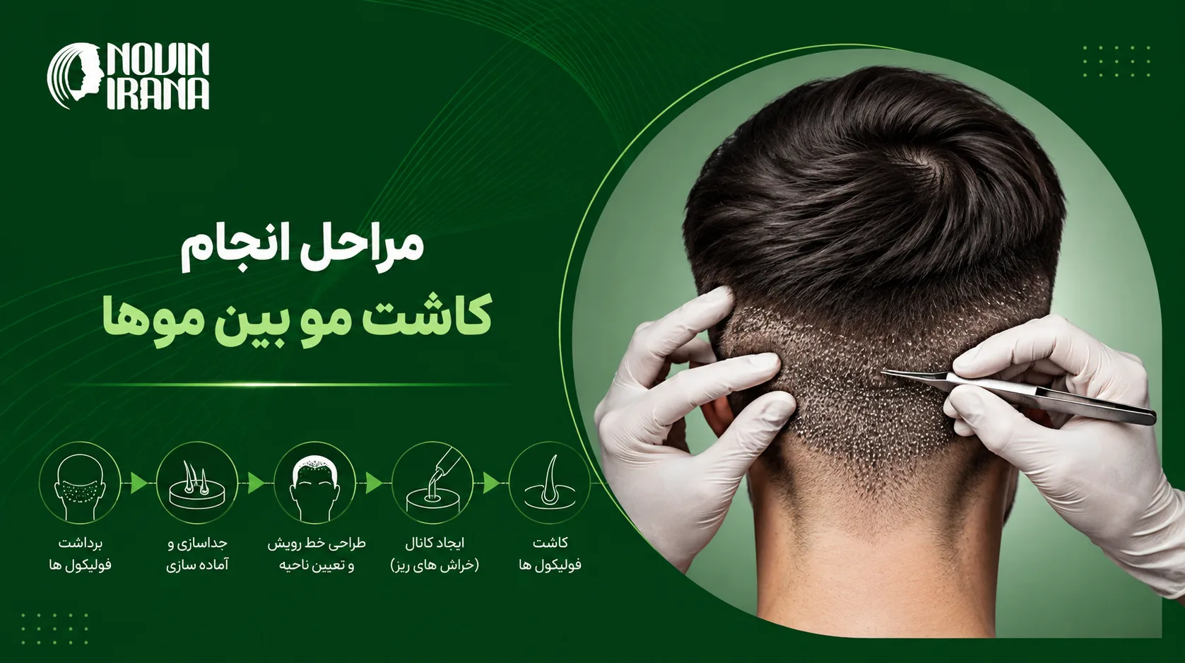 مراحل انجام کاشت مو بین موها